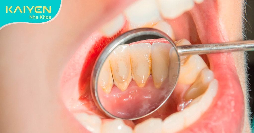 Mảng bám cao răng ở chân răng gây viêm lợi