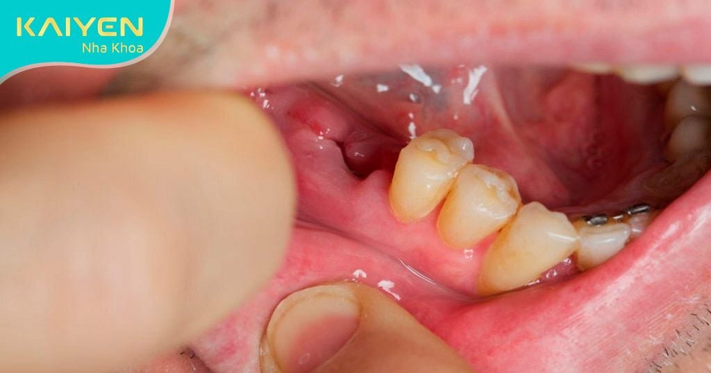 Mất răng dẫn đến nhiều vấn đề răng miệng nguy hiểm