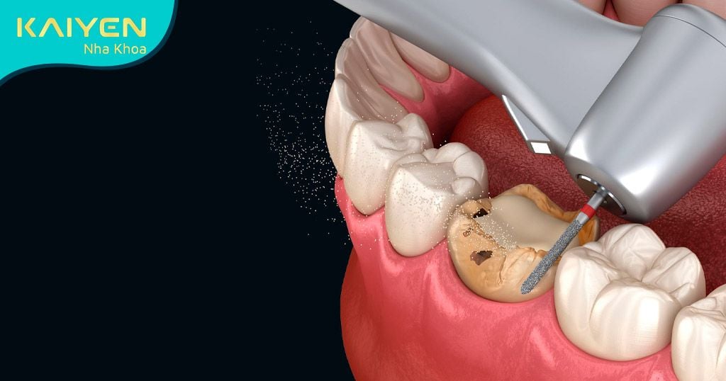 Điều trị bệnh lý sâu răng, viêm nướu khiến răng cấm bị lung lay