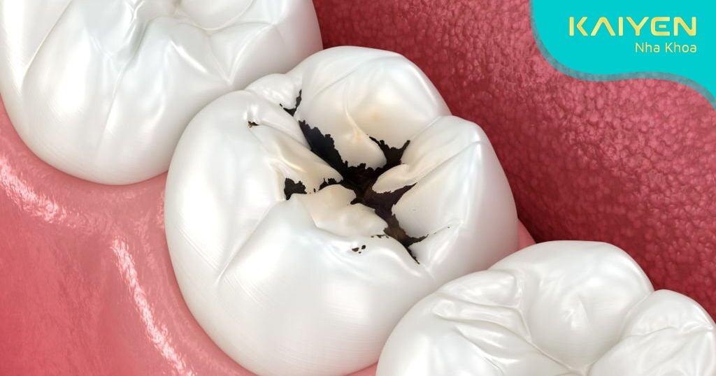 Răng cấm bị sâu phải làm sao? Cách xử lý răng sâu triệt để nhất