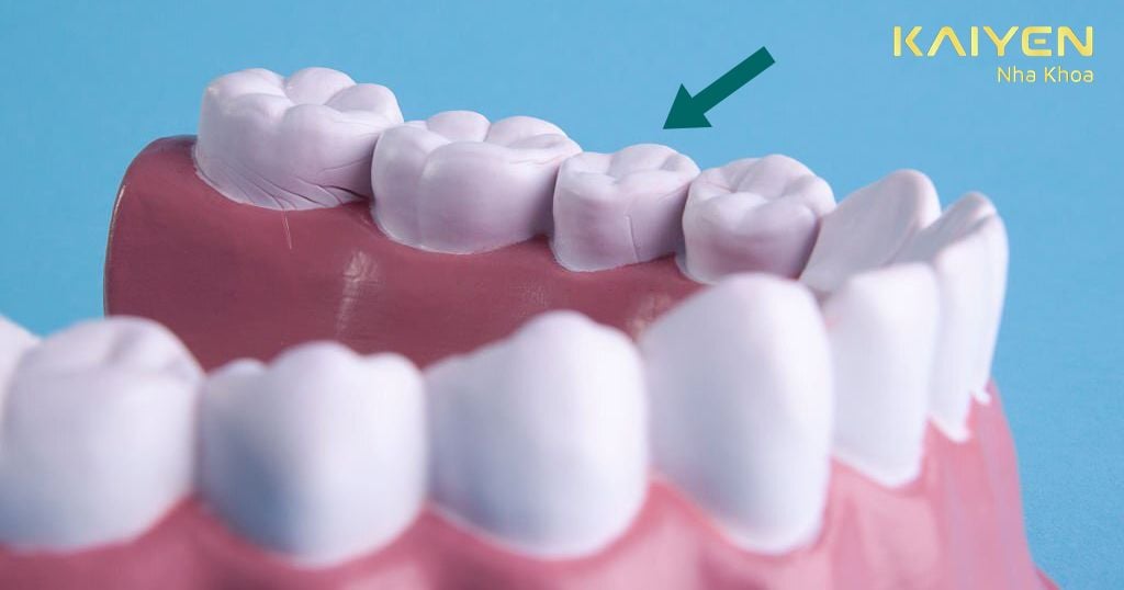 Răng cấm có vị trí là răng thứ 6 trên cung hàm