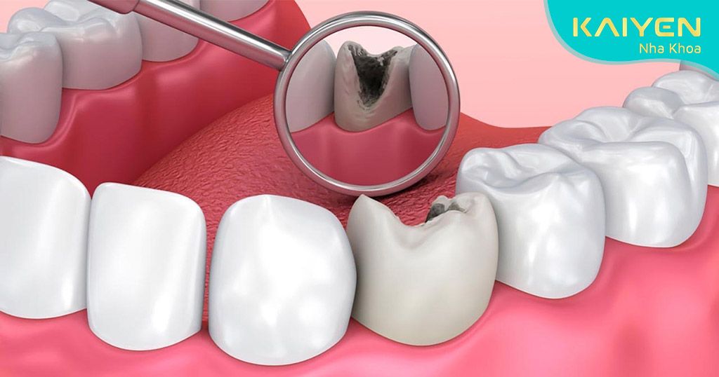 Răng sâu là bệnh lý thường gặp phải