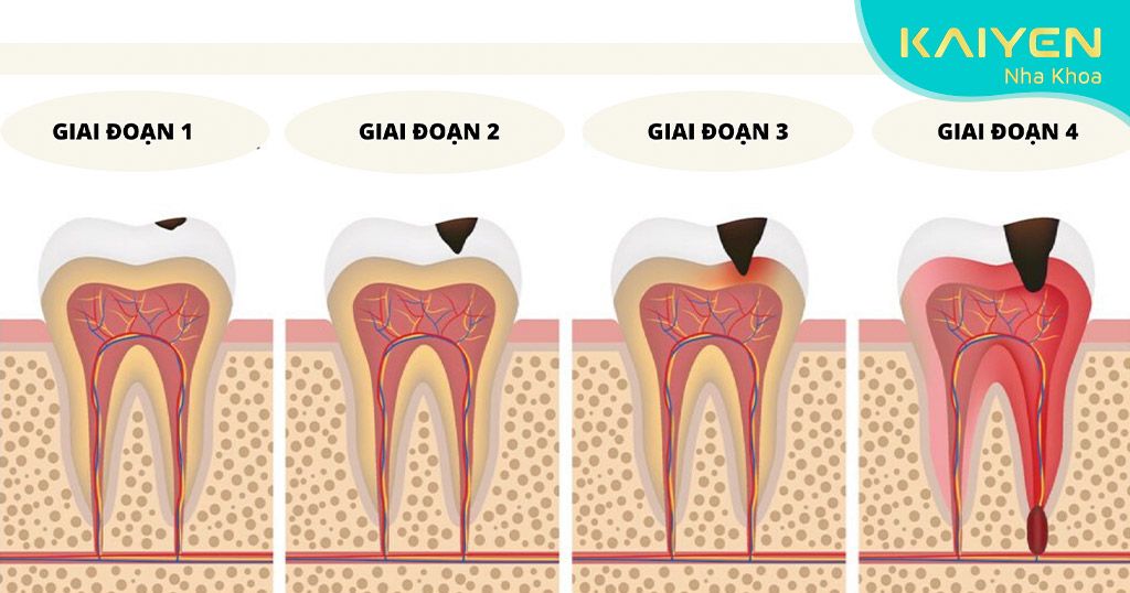 Quá trình răng bị sâu