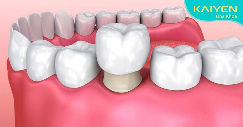 Trồng răng sứ sau khi điều trị sâu răng