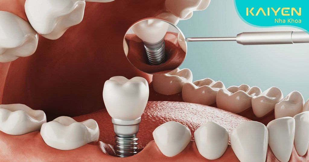 Trồng răng giả bằng kỹ thuật Implant