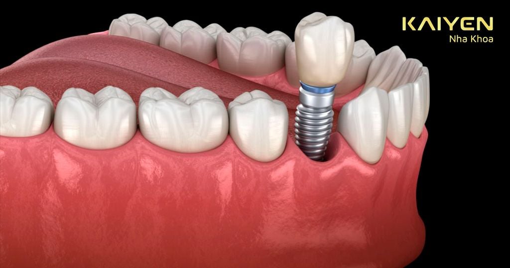 Cấy ghép Implant giúp ngăn chặn biến chứng tiêu xương