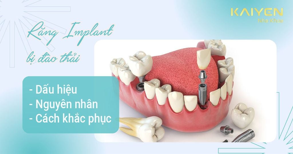 Răng Implant bị đào thải như nào? Nguyên nhân và cách khắc phục