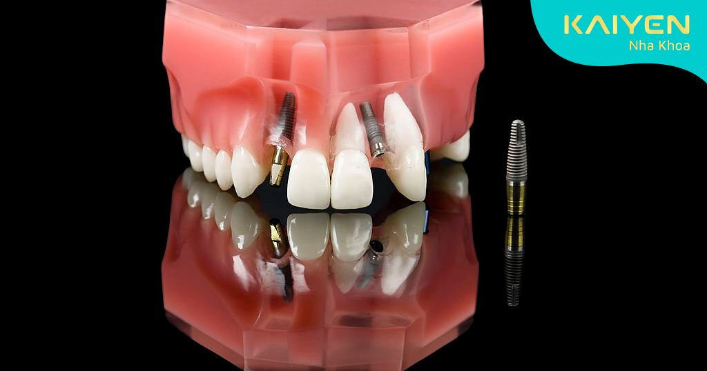 Implant bị đào thải khi xương hàm và trụ không thể tương thích