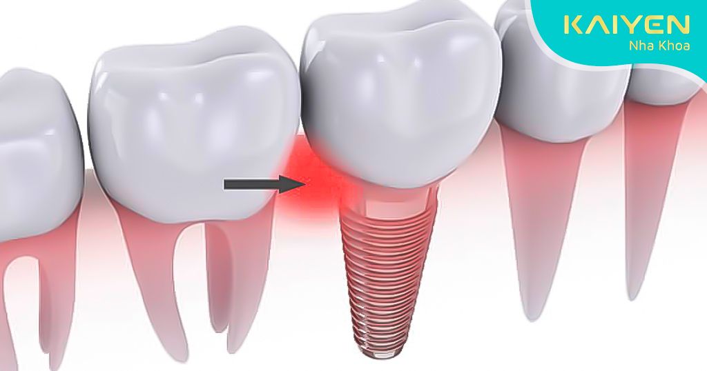 Sưng đau tại vị trí cấy ghép Implant – Dấu hiệu Implant bị đào thải