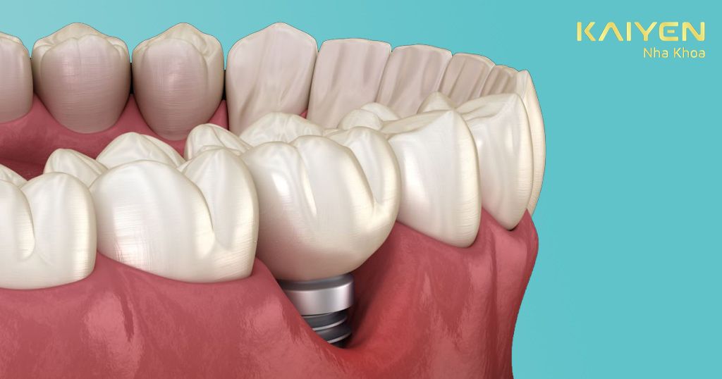 Nhiễm khuẩn sau cấy ghép Implant dẫn đến sưng phù nề, lộ trụ