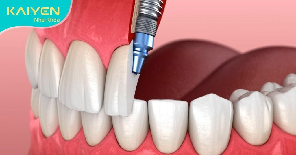 Răng Implant bị vỡ phải làm sao? Nguyên nhân và cách điều trị