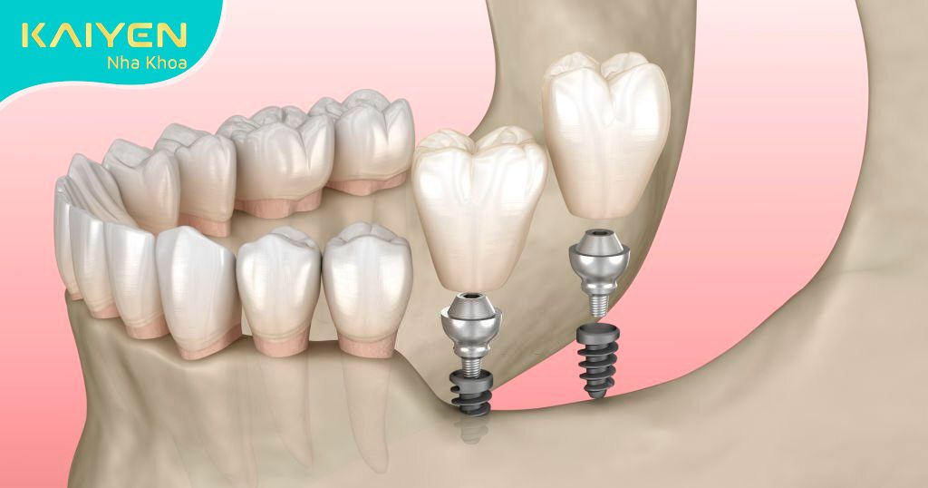 Trụ Implant lựa chọn phải có kích cỡ phù hợp