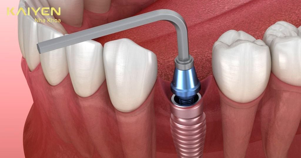Răng Implant bị vỡ cần thay thế mão sứ hoặc trụ Implant