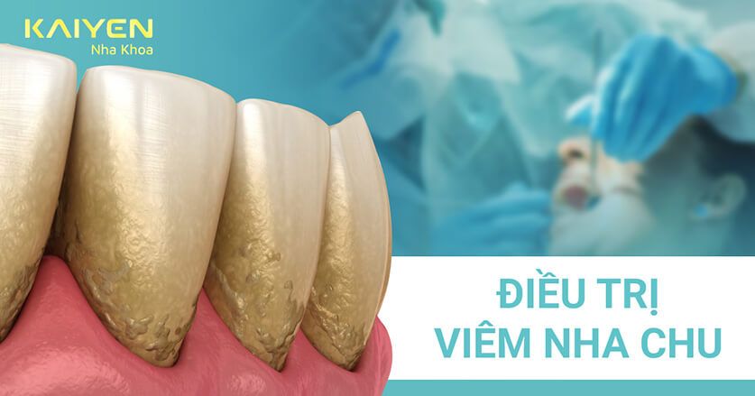 viêm nha chu khiến răng implant lung lay