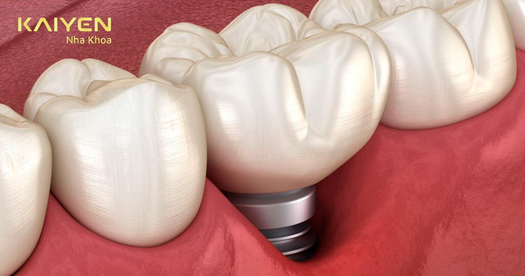 Tụt nướu là dấu hiệu của răng Implant bị viêm