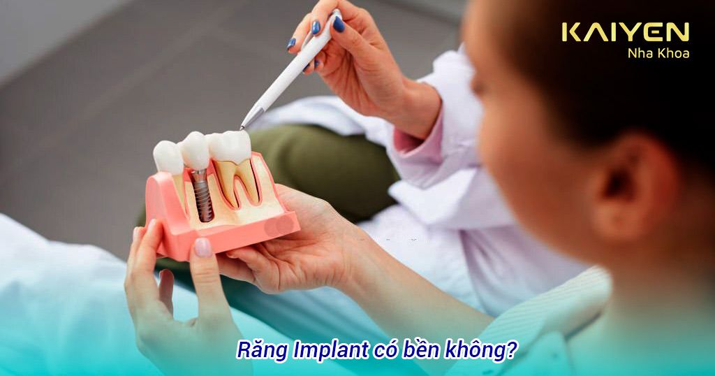 Răng Implant có bền không?