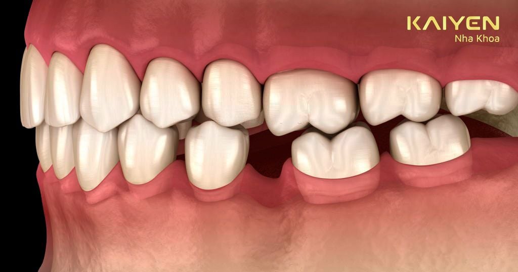 Trồng răng Implant giúp ngăn chặn biến chứng tiêu xương