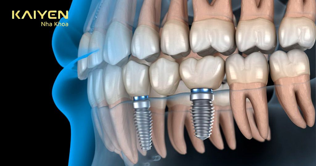 Trụ Implant Đức được chế tạo bằng những đường ren xoắn đều