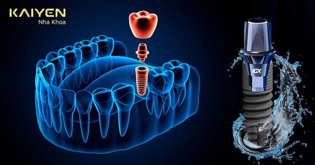 Trụ răng Implant Đức ICX được xử lý bằng công nghệ siêu thấm ướt