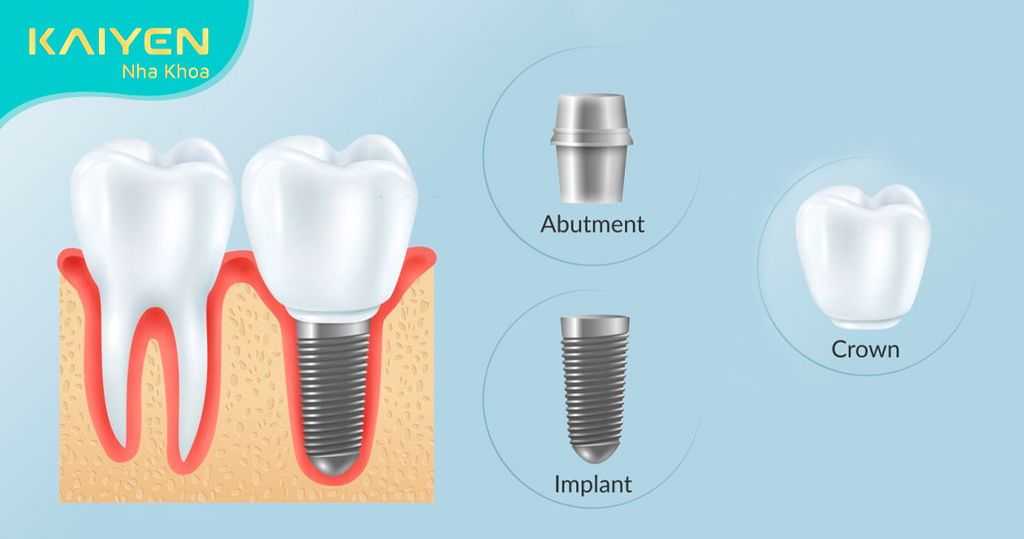 Trụ Implant đặt trong xương hàm thay thế chân răng