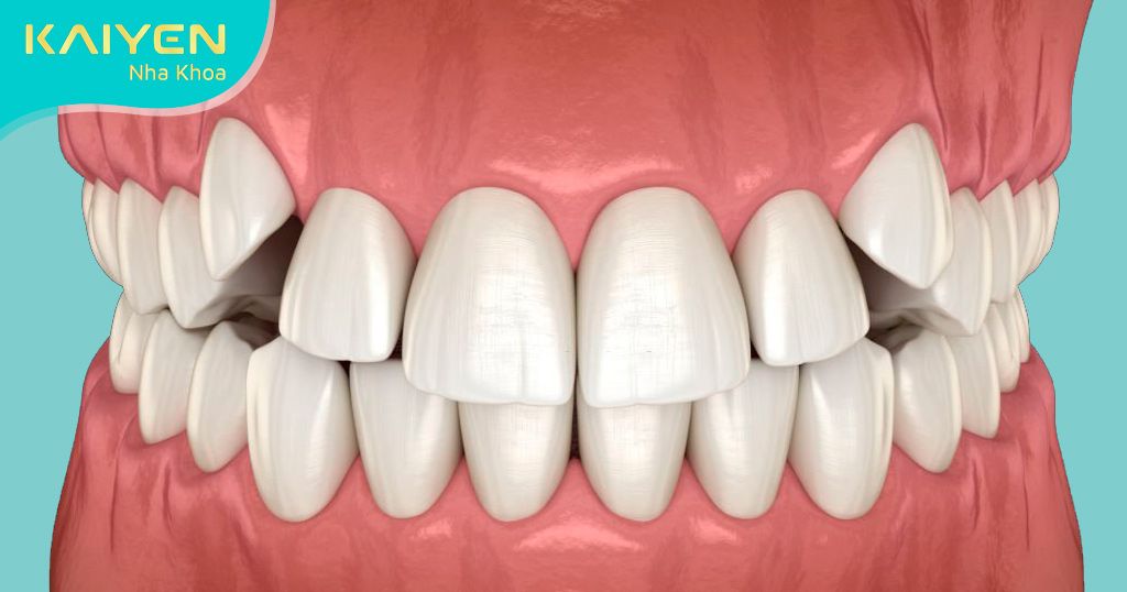 Răng khểnh đẹp hay xấu tùy vào đặc điểm của răng