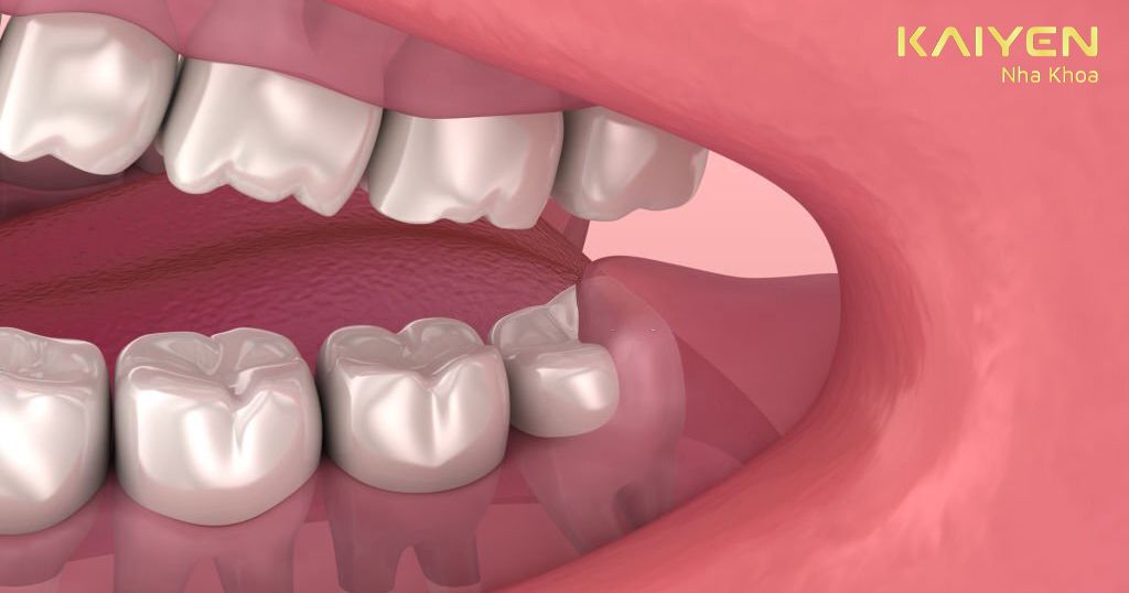 Răng khôn không cố định độ tuổi mọc tùy thuộc vào cơ địa mỗi người