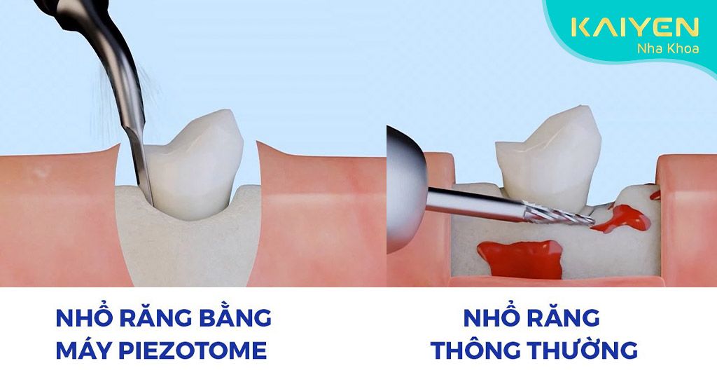 Nhổ răng số 8 mọc lệch 90 độ bằng máy Piezotome