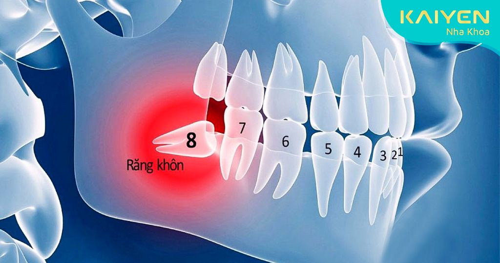 Răng khôn là răng hàm lớn thứ 3 hay còn gọi là răng số 8