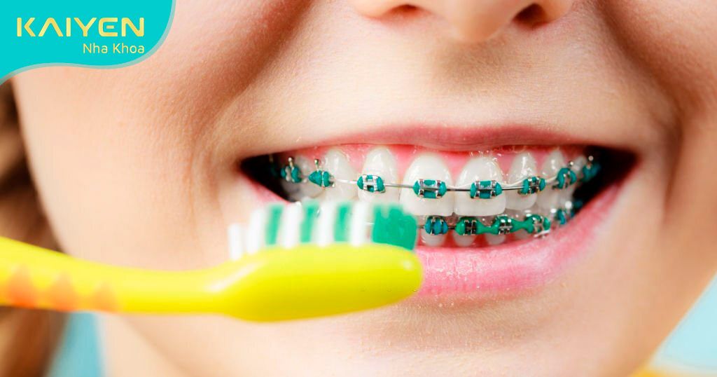 Thói quen chăm sóc răng không đúng cách có thể khiến răng bị lung lay khi chỉnh nha