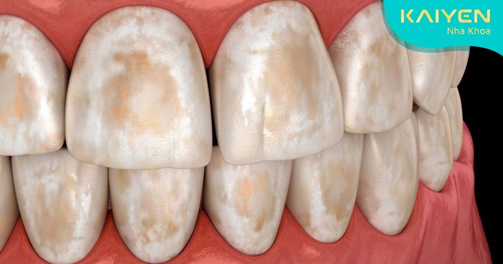 Răng nhiễm Fluor là gì? Nguyên nhân và cách tẩy trắng răng