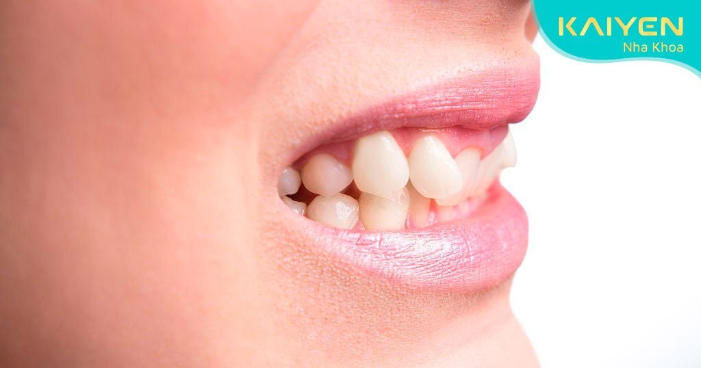 Răng quặp khiến vệ sinh răng miệng khó khăn