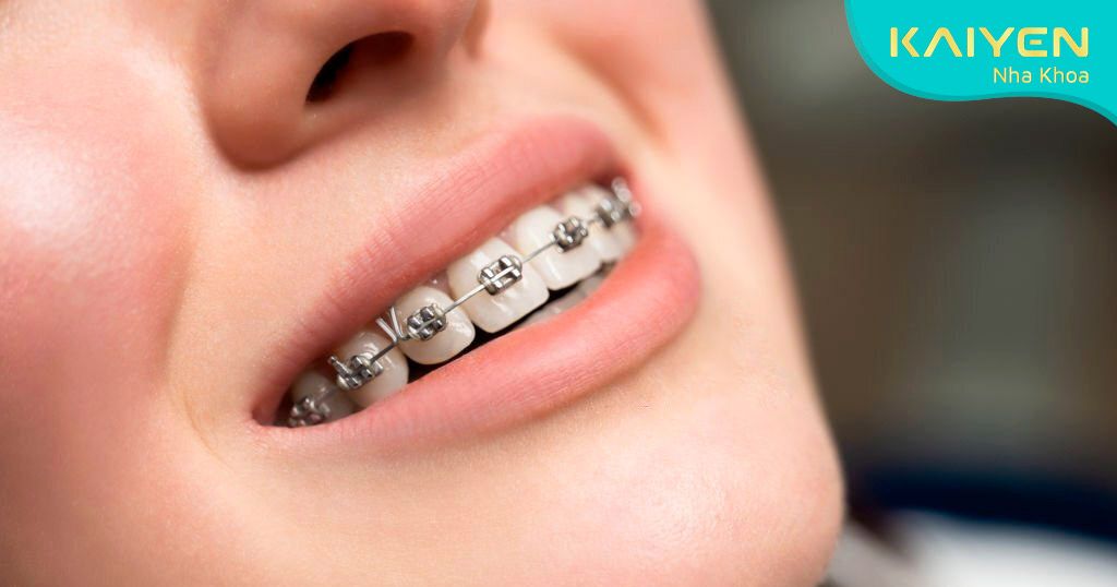 Tình trạng răng quặp có thể được khắc phục nhờ phương pháp niềng răng
