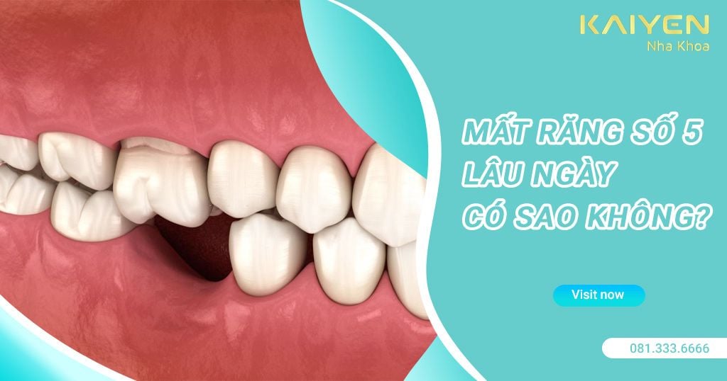 Mất răng số 5 lâu ngày có sao không?