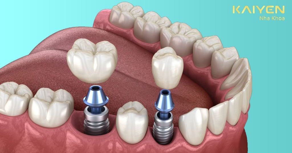 Phục hình răng mất bằng phương pháp cấy ghép Implant