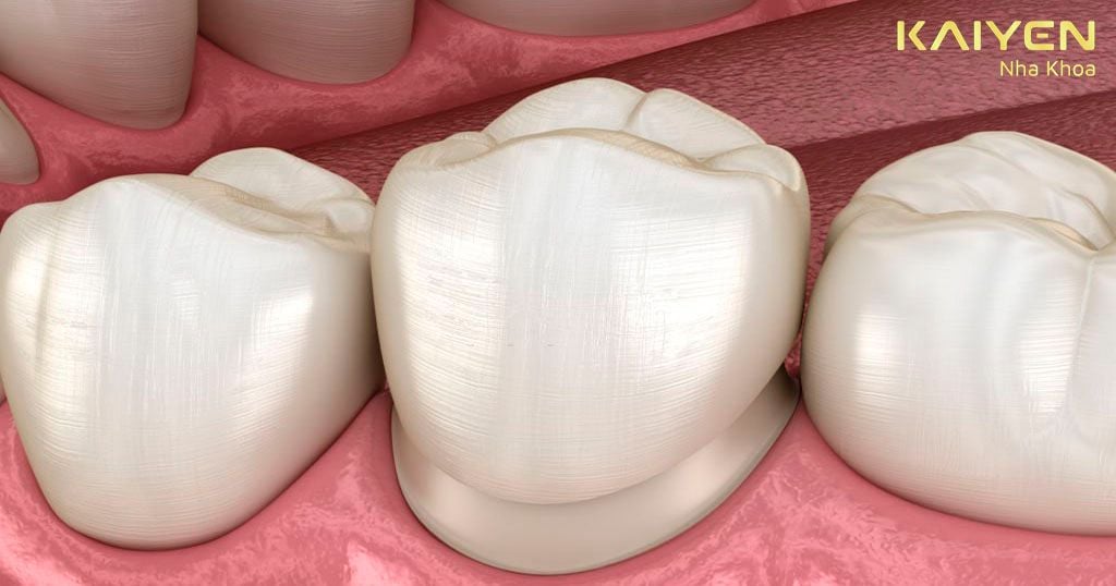 Dấu hiệu răng sứ bị hở, nguyên nhân và cách khắc phục