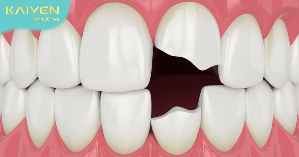 Răng sứ bị hỏng: Nguyên nhân, hậu quả và cách giải quyết