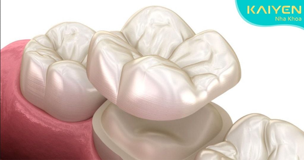 Răng sứ là răng giả vẫn có thể bị rơi ra ngoài nếu có nhiều tác động xấu