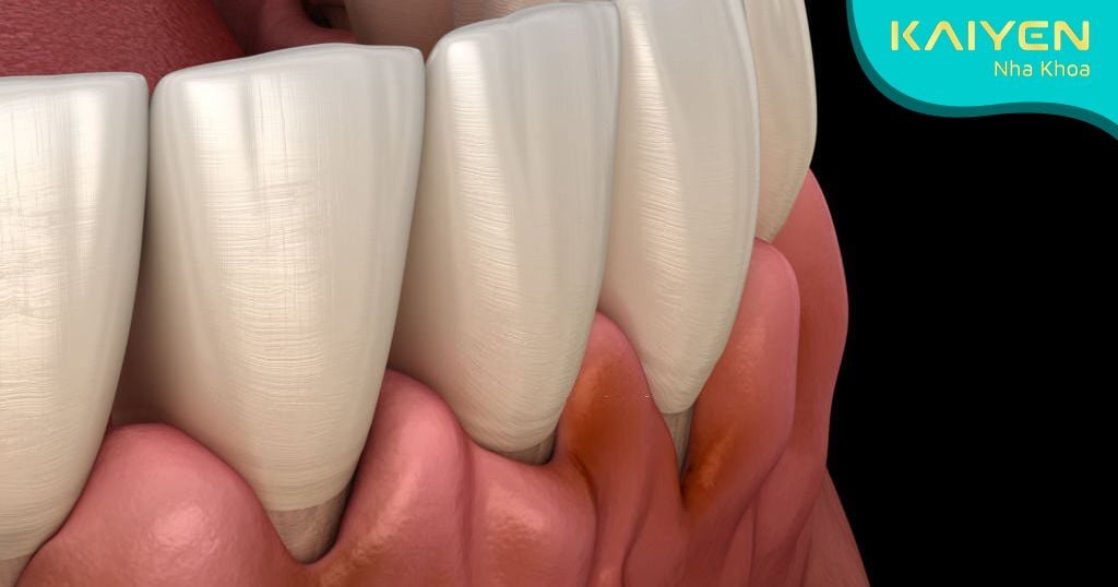 Nhiễm trùng khoang miệng khi răng sứ bị mẻ