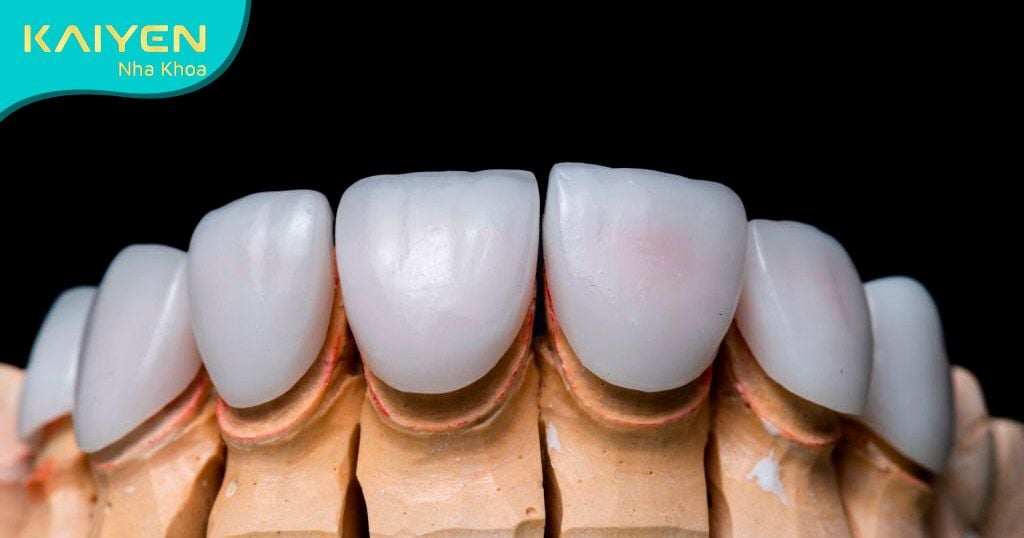 Răng sứ Cercon Zirconia