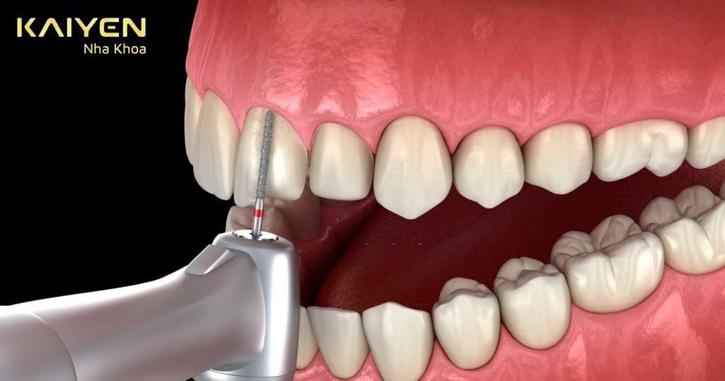 Mài răng khiến răng càng thêm nhạy cảm, dễ bị ê buốt