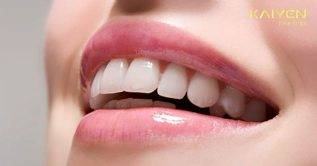 Răng toàn sứ có tính thẩm mỹ cao hơn răng sứ kim loại