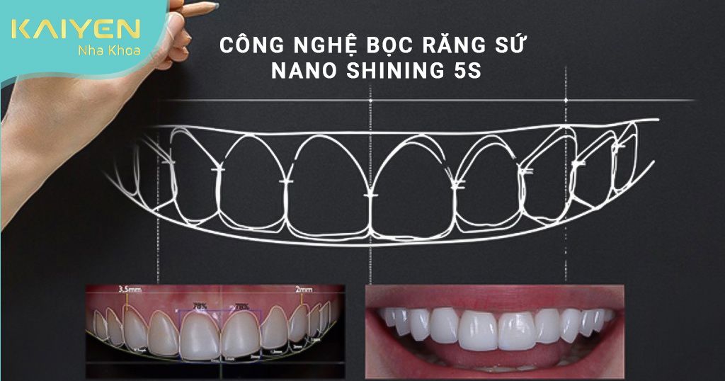 Công nghệ bọc răng sứ Nano 5S