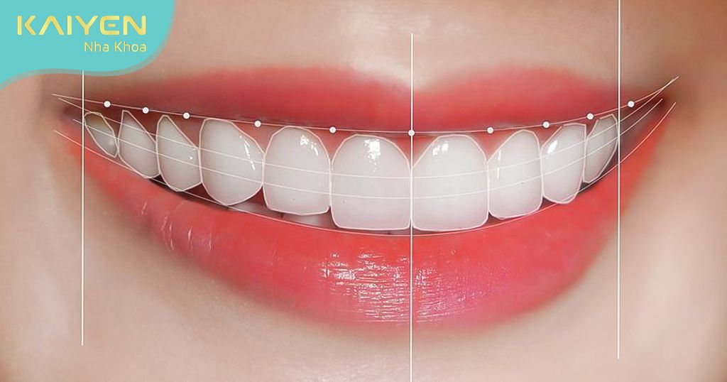 Nano Shining 5S tạo răng sứ trắng sáng tự nhiên, cân đối chuẩn tỷ lệ vàng