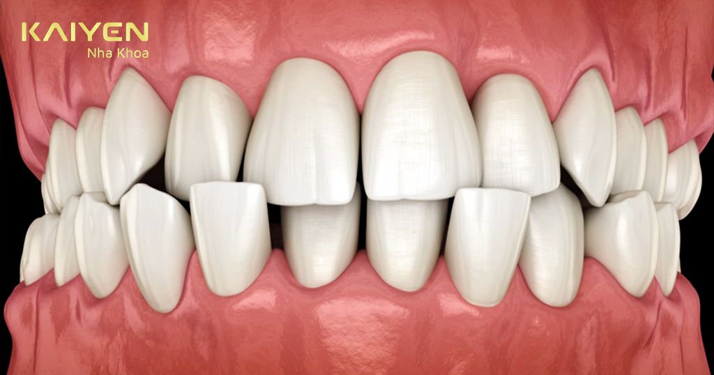 Bọc răng sứ nguyên hàm phù hợp với răng mọc lệch mức độ nhẹ
