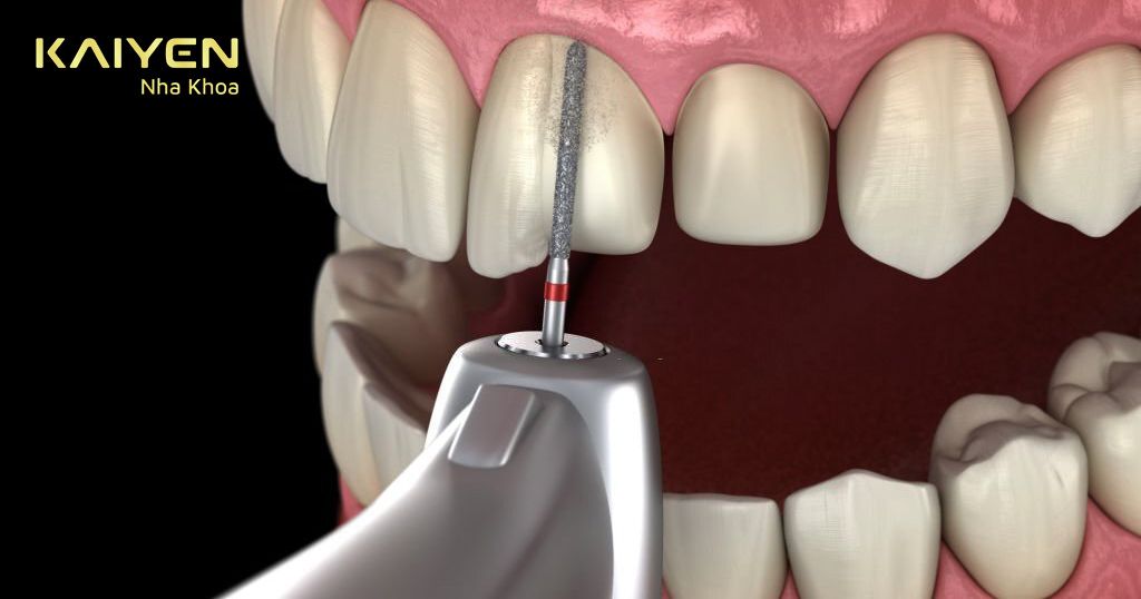 Bọc răng sứ nguyên hàm phải mài nhiều răng liên tiếp