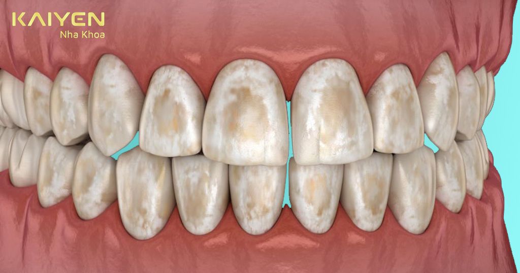 Các khuyết điểm răng, răng bị nhiễm Fluor không thể tẩy trắng đều có thể bọc răng Zolid