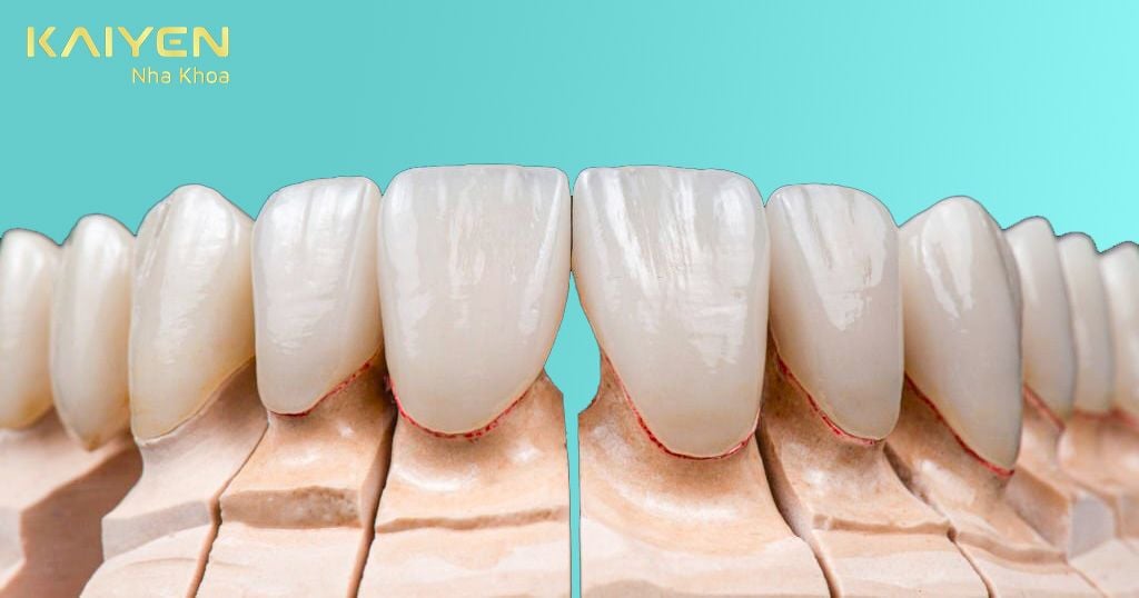 Giá của răng Zolid khá cao và nó phụ thuộc vào nhiều yếu tố