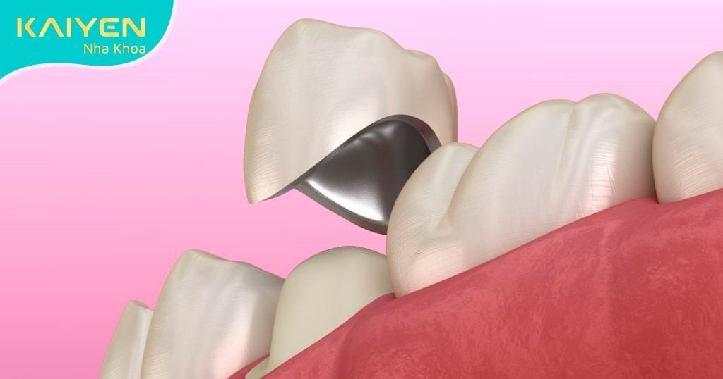 Răng tạm khi làm răng sứ là gì? Quy trình gắn răng tạm