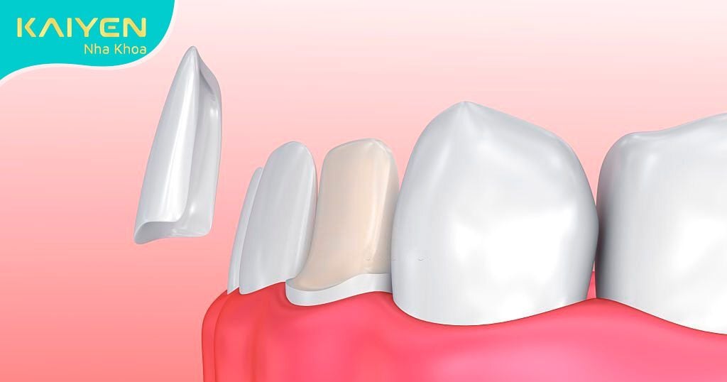 Lắp răng tạm khi chờ hoàn tất răng sứ
