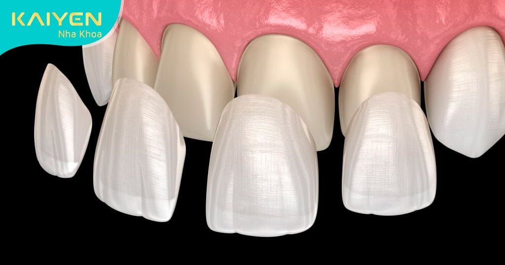 Răng tạm khi làm răng sứ giúp duy trì thẩm mỹ cho hàm răng